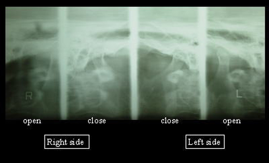 4.顎関節レントゲンの画像 1
